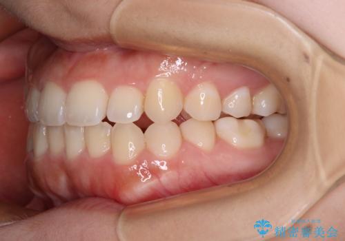 前歯のクロスバイトを改善 インビザライン・モデレートによる矯正治療の治療中