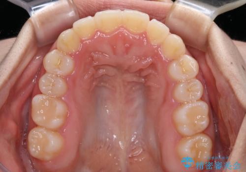 前歯のクロスバイトを改善　インビザライン・モデレートによる矯正治療の治療中