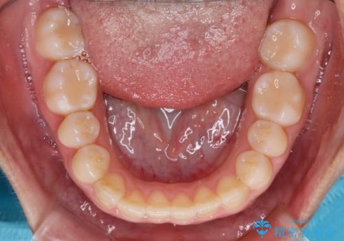 前歯のクロスバイトを改善 インビザライン・モデレートによる矯正治療の治療中