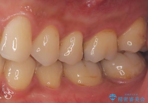 【セラミックインレー】他院で詰めた銀歯がフロスをしたら取れた!の治療前