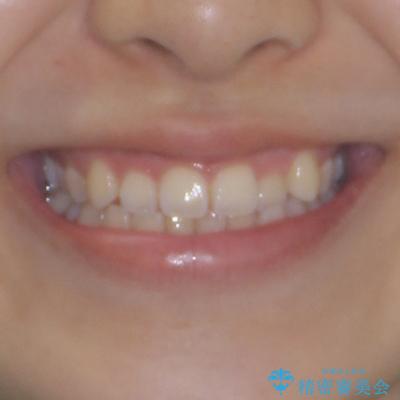 前歯のクロスバイトを改善 インビザライン・モデレートによる矯正治療の治療前(顔貌)