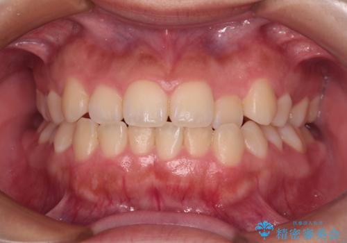 前歯のクロスバイトを改善　インビザライン・モデレートによる矯正治療の治療前