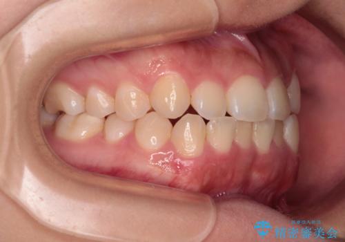 前歯のクロスバイトを改善 インビザライン・モデレートによる矯正治療の治療前