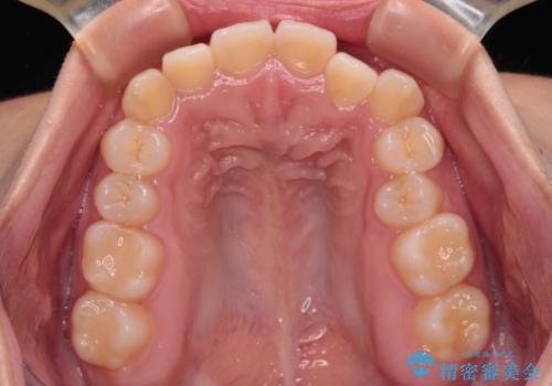 前歯のクロスバイトを改善 インビザライン・モデレートによる矯正治療の治療前