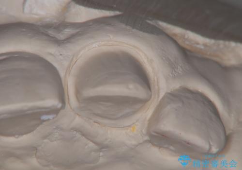 前歯が欠けた セラミッククラウンの治療後