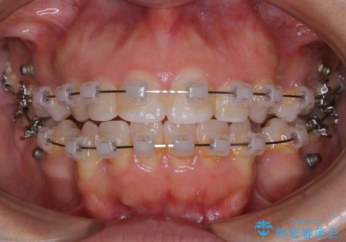 【抜歯】口元を引っ込めたい ワイヤー矯正の治療中