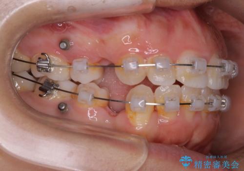 【抜歯】口元を引っ込めたい ワイヤー矯正の治療中