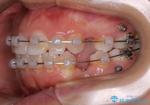 【抜歯】口元を引っ込めたい ワイヤー矯正の治療中