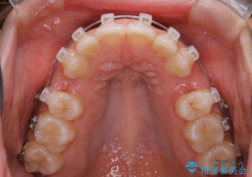 【抜歯】口元を引っ込めたい ワイヤー矯正の治療中