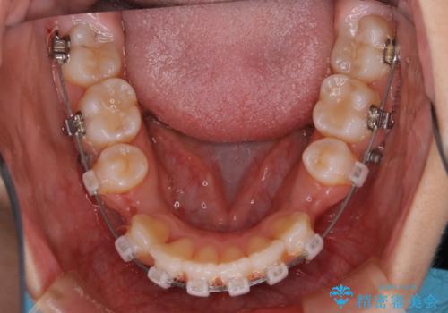 【抜歯】口元を引っ込めたい ワイヤー矯正の治療中