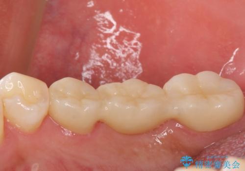 金属のブリッジをやり替えたいの治療後