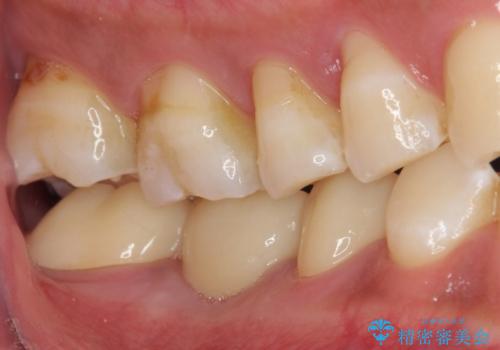 金属のブリッジをやり替えたいの治療後