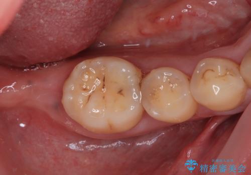 部分矯正で咬み合わせを改善　奥歯のインプラント治療の治療中