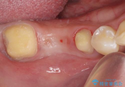 金属のブリッジをやり替えたいの治療中