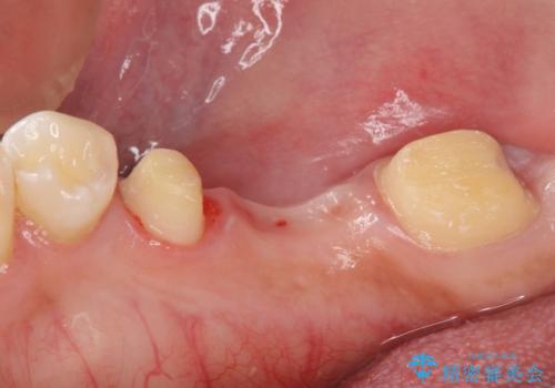 金属のブリッジをやり替えたいの治療中