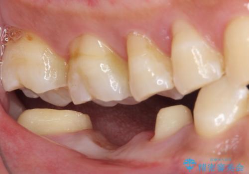 金属のブリッジをやり替えたいの治療中