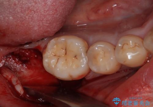部分矯正で咬み合わせを改善　奥歯のインプラント治療の治療中