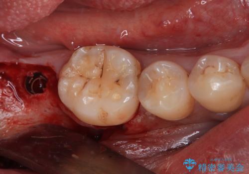部分矯正で咬み合わせを改善 奥歯のインプラント治療の治療後