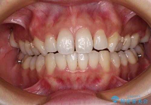 補助装置を用いて奥歯の咬み合わせを事前に改善 インビザラインによる矯正治療の治療中