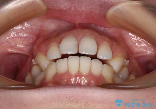 補助装置を用いて奥歯の咬み合わせを事前に改善 インビザラインによる矯正治療の治療中