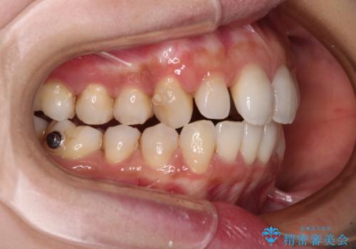 補助装置を用いて奥歯の咬み合わせを事前に改善　インビザラインによる矯正治療の治療中