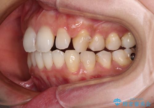 補助装置を用いて奥歯の咬み合わせを事前に改善 インビザラインによる矯正治療の治療中