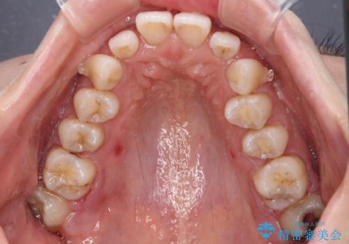 補助装置を用いて奥歯の咬み合わせを事前に改善 インビザラインによる矯正治療の治療中