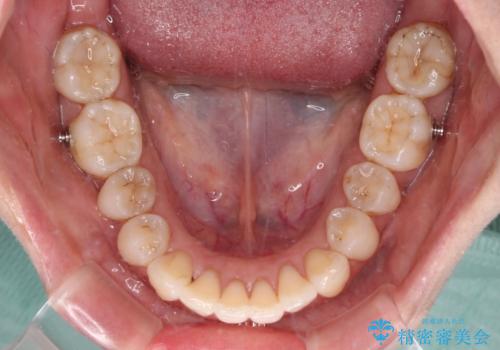 補助装置を用いて奥歯の咬み合わせを事前に改善 インビザラインによる矯正治療の治療中