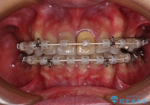 突出した前歯を引っ込める　ワイヤー装置での抜歯矯正の治療中