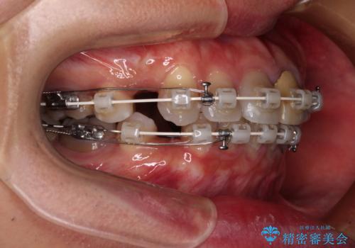 突出した前歯を引っ込める　ワイヤー装置での抜歯矯正の治療中