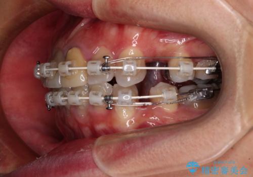 突出した前歯を引っ込める ワイヤー装置での抜歯矯正の治療中