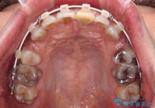 突出した前歯を引っ込める ワイヤー装置での抜歯矯正の治療中