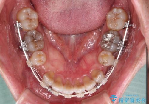 突出した前歯を引っ込める ワイヤー装置での抜歯矯正の治療中