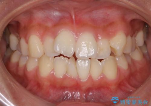【非抜歯】マイクロインプラントで効率よく矯正を!の症例 治療前