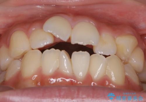 【非抜歯】マイクロインプラントで効率よく矯正を!の治療前