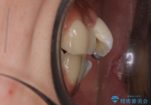 【非抜歯】マイクロインプラントで効率よく矯正を!の治療前