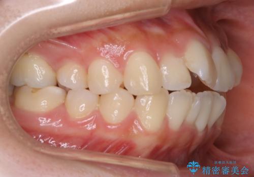 【非抜歯】マイクロインプラントで効率よく矯正を!の治療前