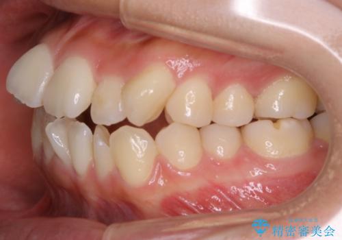 【非抜歯】マイクロインプラントで効率よく矯正を!の治療前