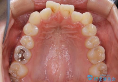 【非抜歯】マイクロインプラントで効率よく矯正を!の治療前