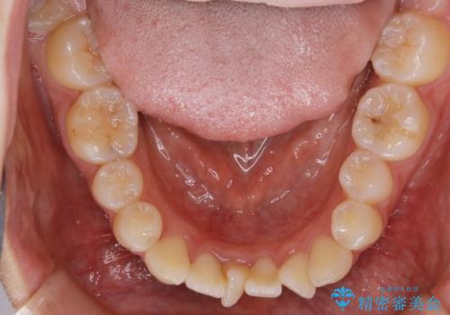 【非抜歯】マイクロインプラントで効率よく矯正を!の治療前