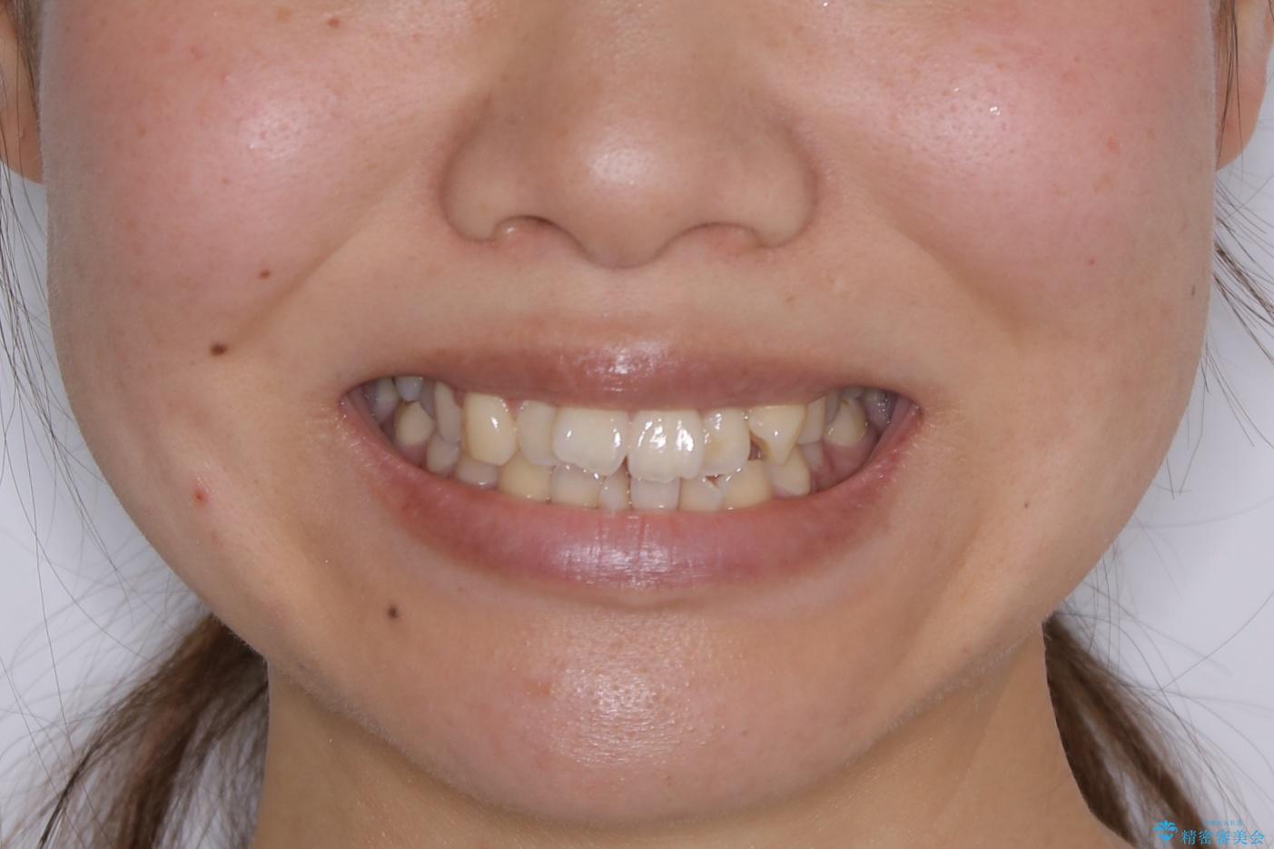 【非抜歯】マイクロインプラントで効率よく矯正を!の治療前(顔貌)