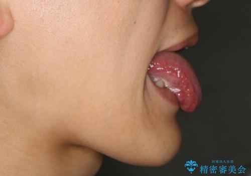 舌小帯切除　レーザー機器で縫合レスの治療前