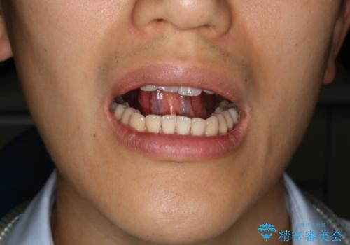 舌小帯切除 レーザー機器で縫合レスの治療前