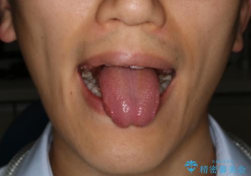 舌小帯切除 レーザー機器で縫合レスの症例 治療前