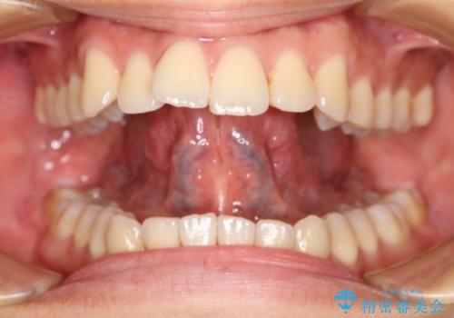 舌小帯切除 レーザー機器で縫合レスの治療前