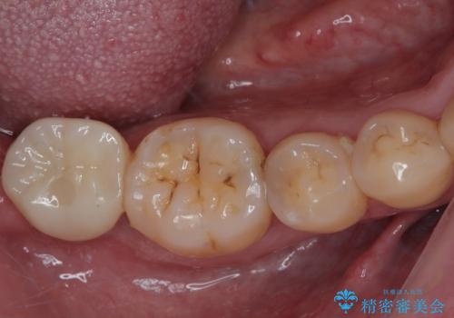 部分矯正で咬み合わせを改善　奥歯のインプラント治療の治療後