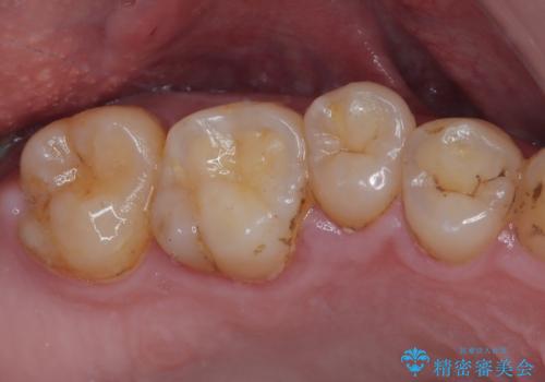 部分矯正で咬み合わせを改善　奥歯のインプラント治療の治療後