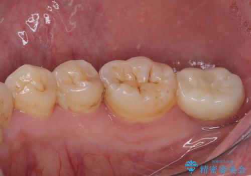 部分矯正で咬み合わせを改善 奥歯のインプラント治療の治療後