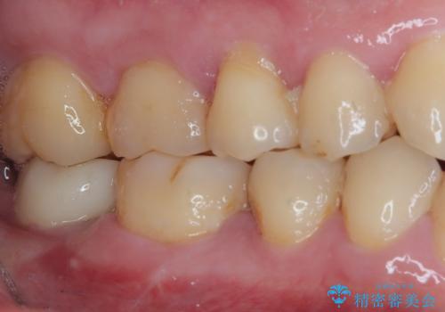 部分矯正で咬み合わせを改善 奥歯のインプラント治療の治療後