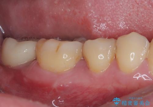 部分矯正で咬み合わせを改善 奥歯のインプラント治療の治療後